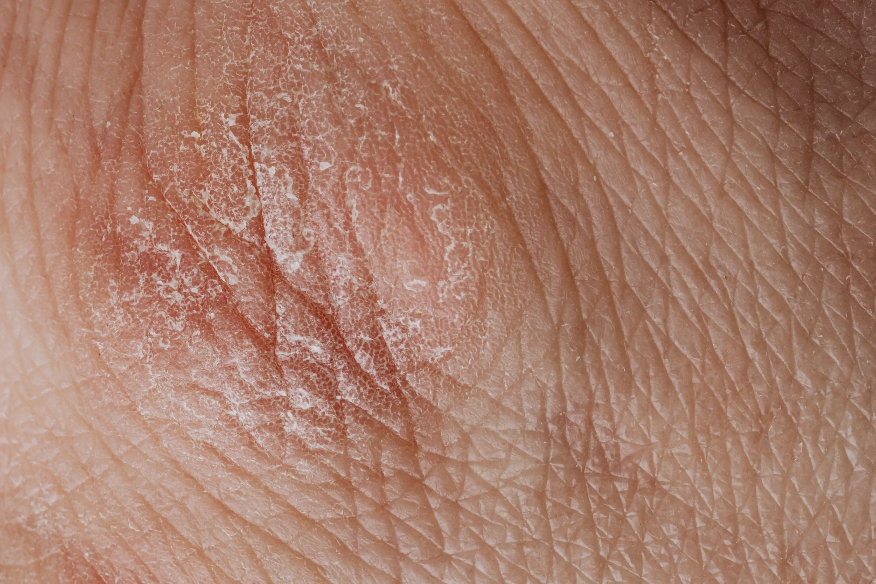 How Does Psoriasis Spread